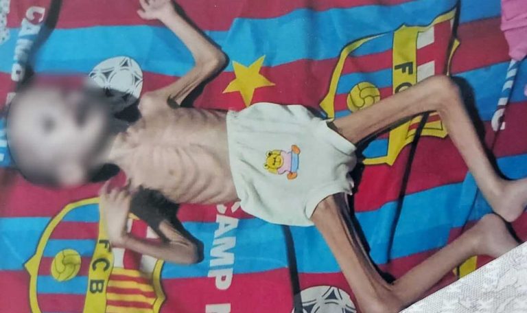 Kini Tinggal Kulit Pembalut Tulang, Reihan Hanya bisa Menangis Saat Sakit Menggerogotinya