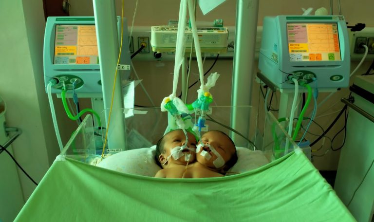 Tim Medis Sudah Dibentuk, Bayi Kembar Siam Asal Padang Pariaman Meninggal Dunia